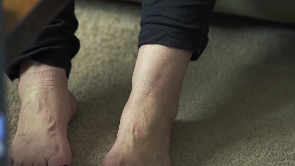 Feet of paraplegic patient walking on machine assisted unweighting